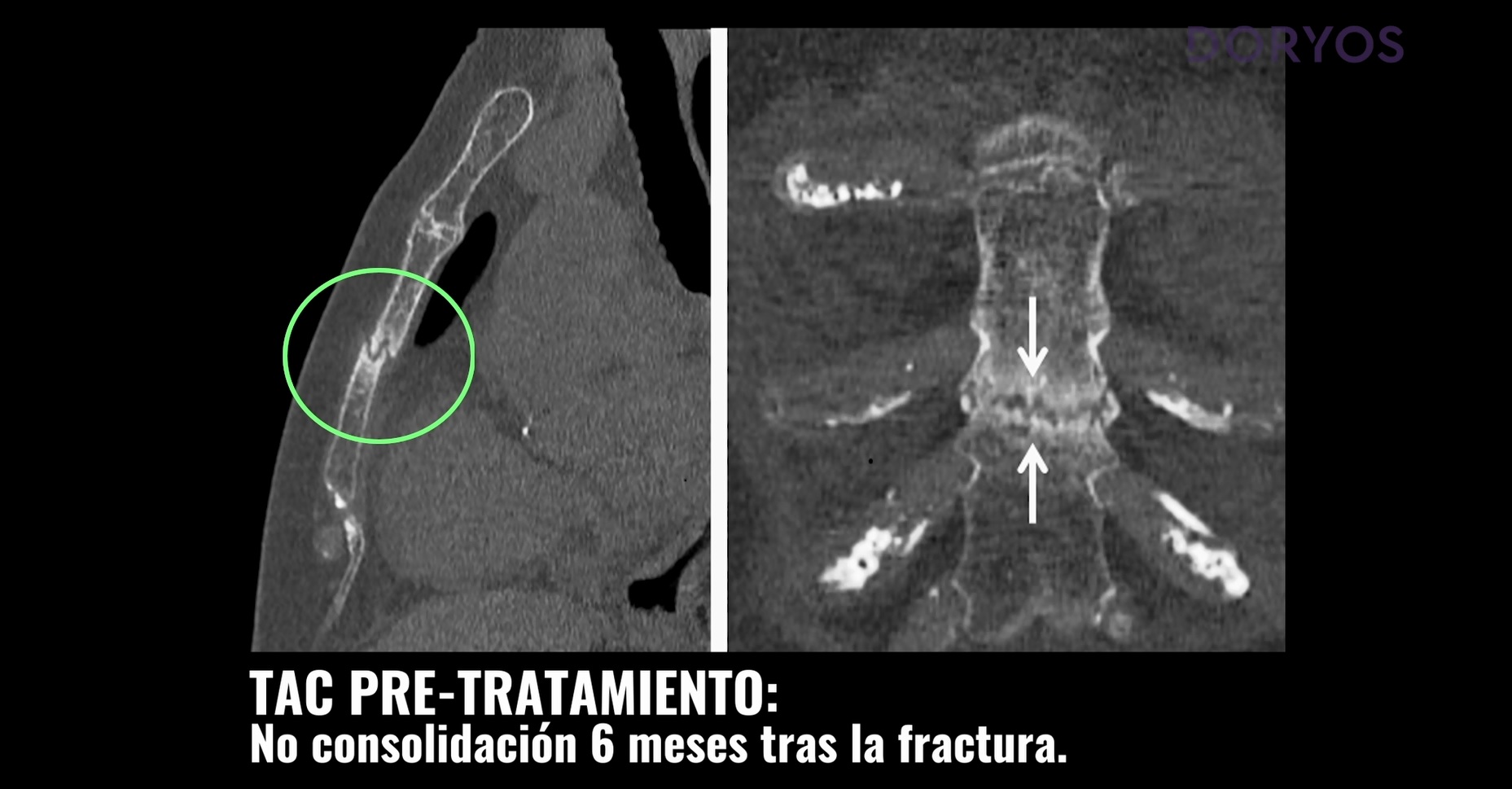 tratamiento-de-la-fractura-no-consolidada-de-estern-n-con-un-f-rmaco