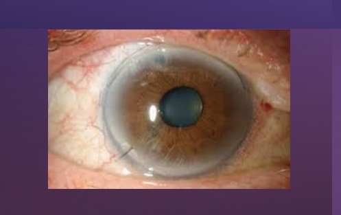 Lente intraocular sales de foco extendido