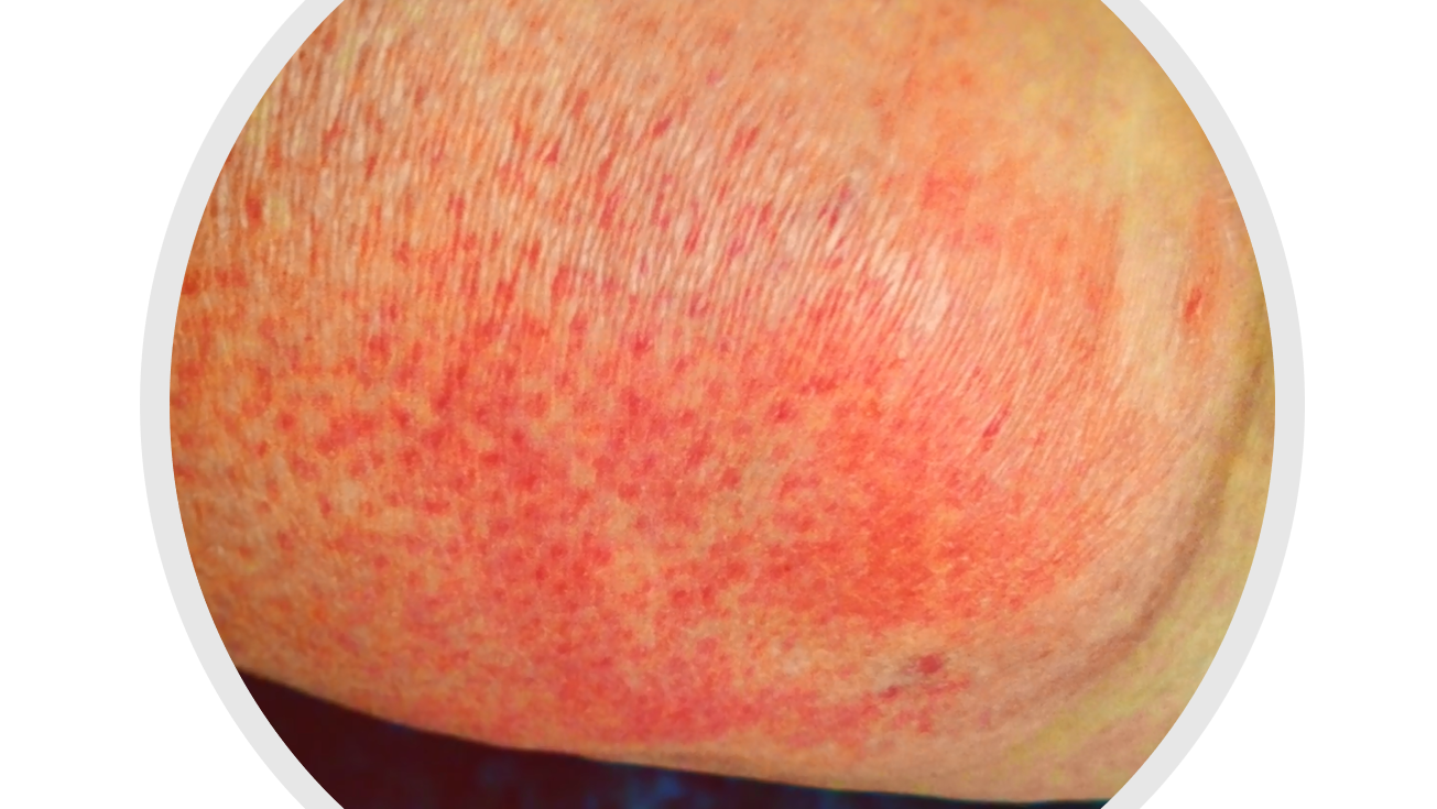 Sintomas De Alergia A Anestesia Odontológica - RETOEDU