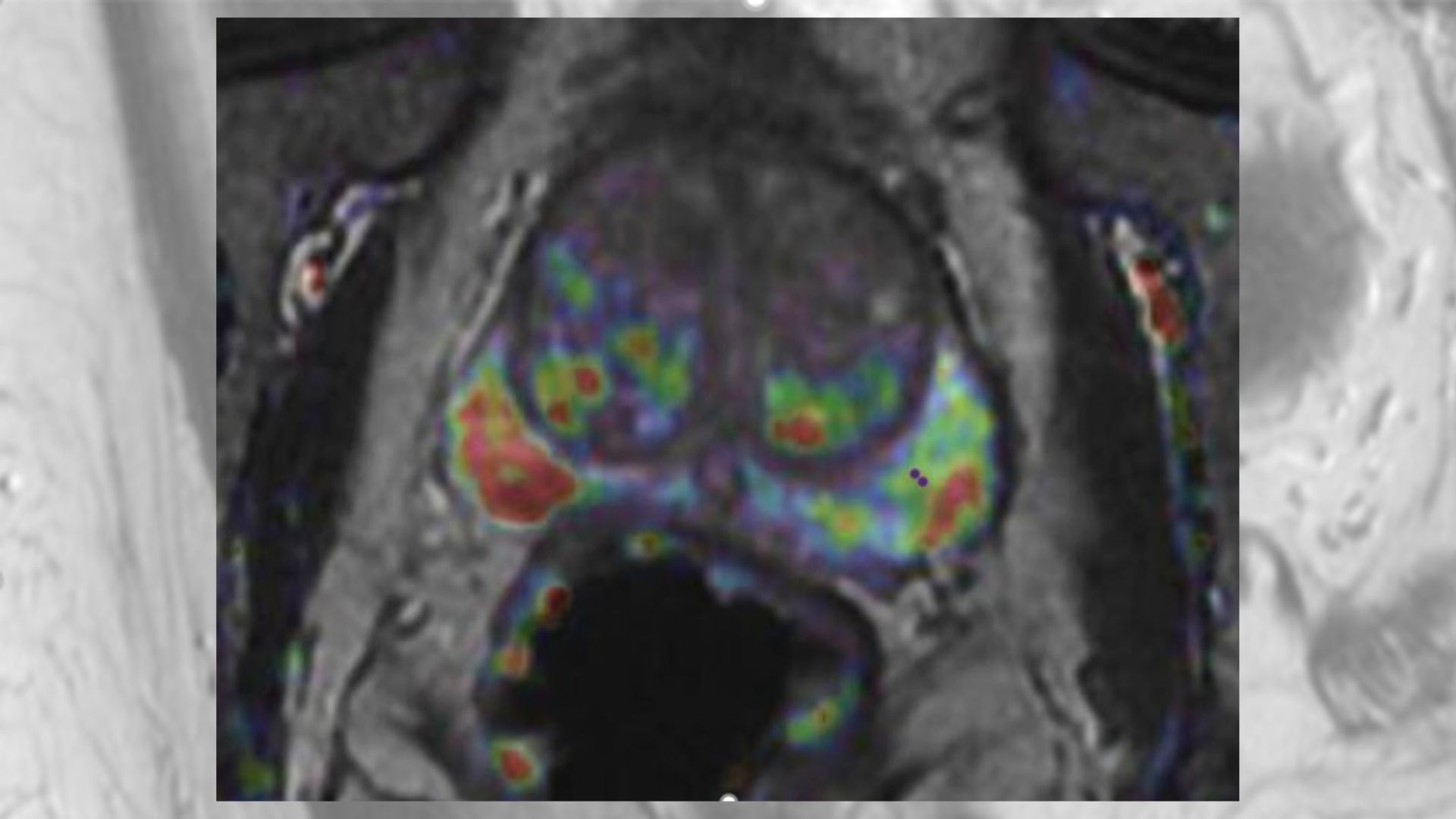 PIRADS v2.1 (2/3): Interpretación e informe . Radiodiagnóstico ...
