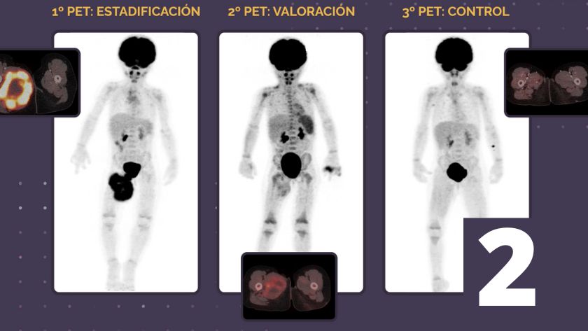 PET/CT Digital en pediatría, parte 2 : Doryos
