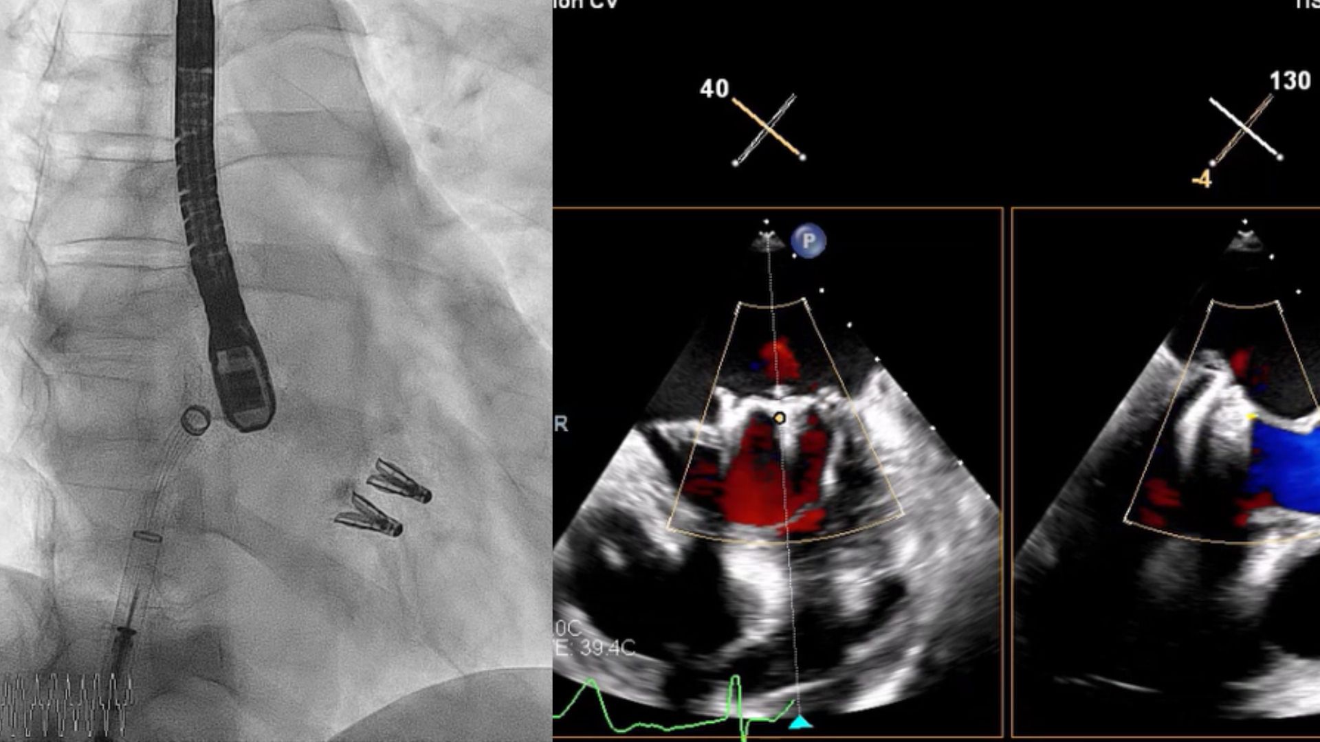 Mitraclip: Reparación valvular mitral percutánea : Doryos