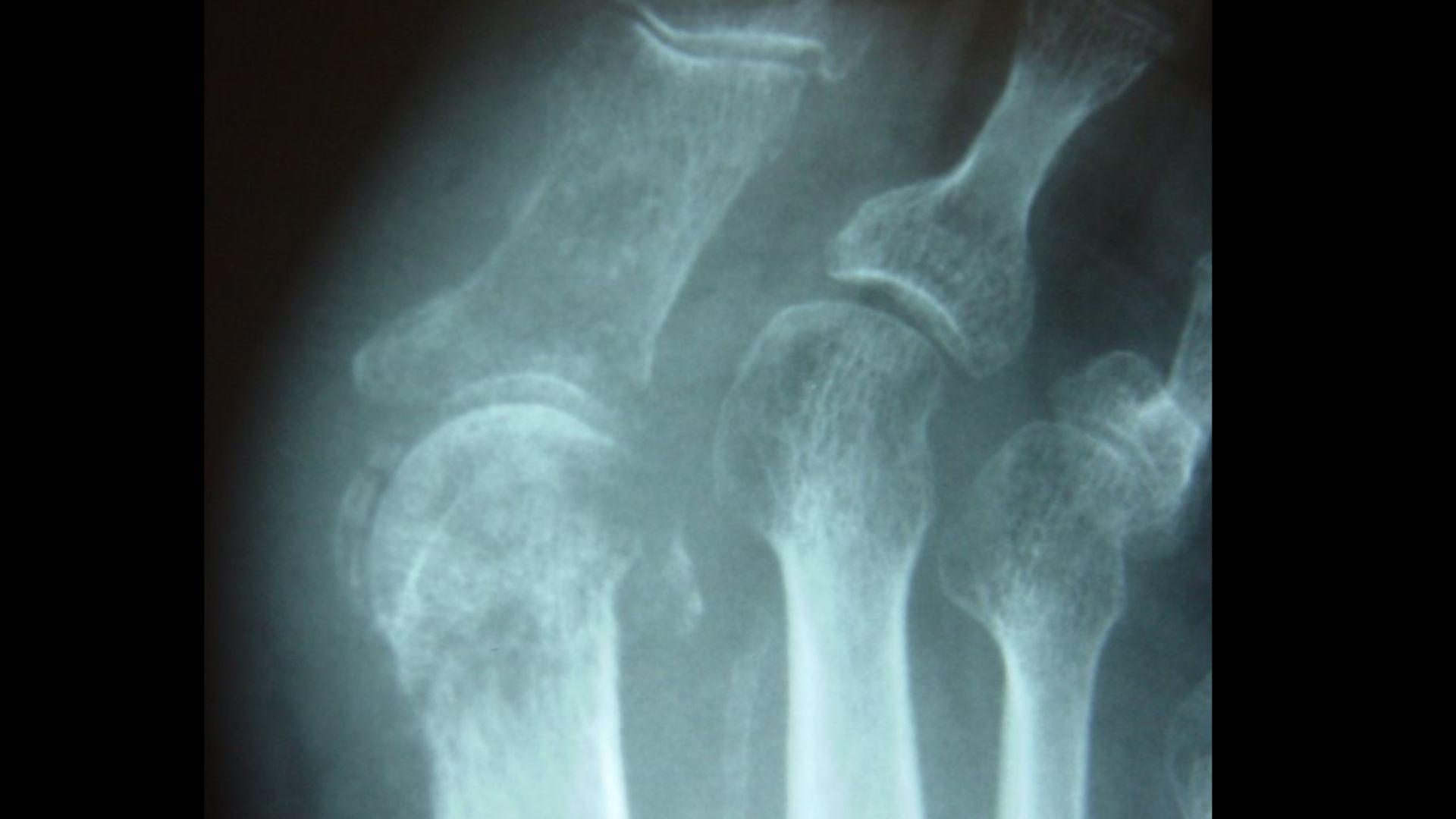 Diagnóstico de la osteomielitis del pie diabético Doryos Doryos