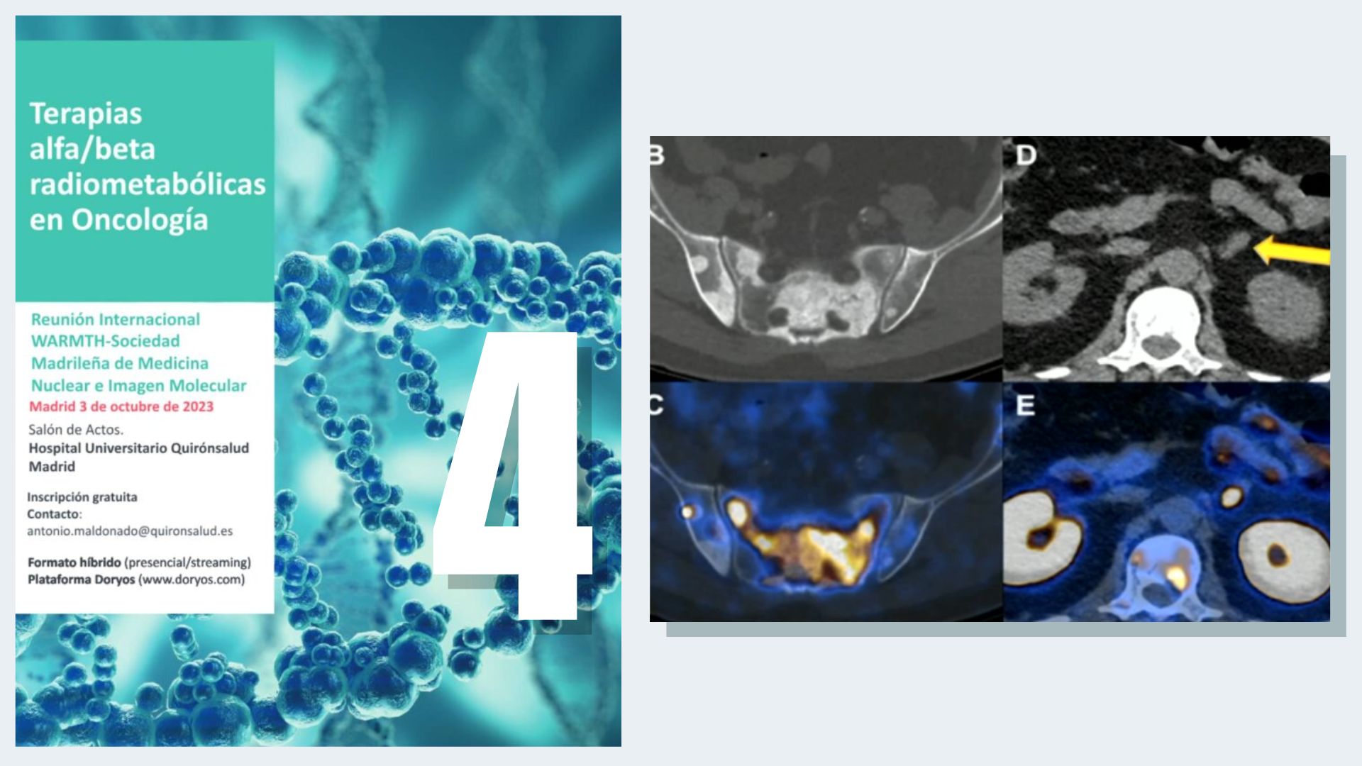 PET-CT con trazadores PSMA en el diagnóstico del cáncer de próstata ...